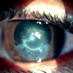Pythium keratitis