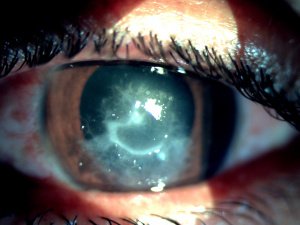 Pythium keratitis: clinical profile and management recommendation