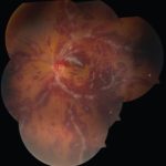 Hemorrhagic Occlusive Retinal Vasculitis (HORV)