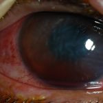 Hyphema