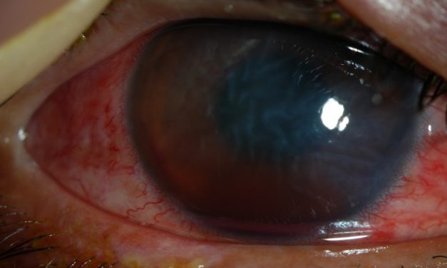 Hyphema Systematic Review: Etiology, Clinical Features, and Treatment Options