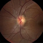 Papilledema