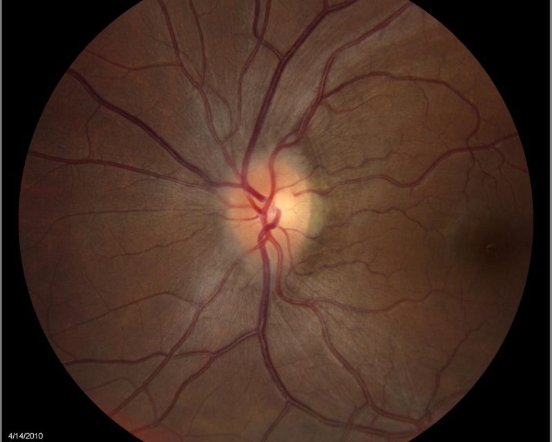 Papilledema: What Ophthalmologists Need to Know