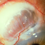 Scleromalacia Perforans
