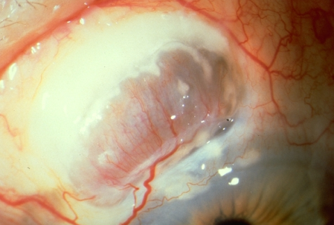 Scleromalacia Perforans: a rare, vision threating lesion