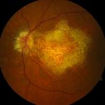 Doyne Honeycomb Retinal Dystrophy