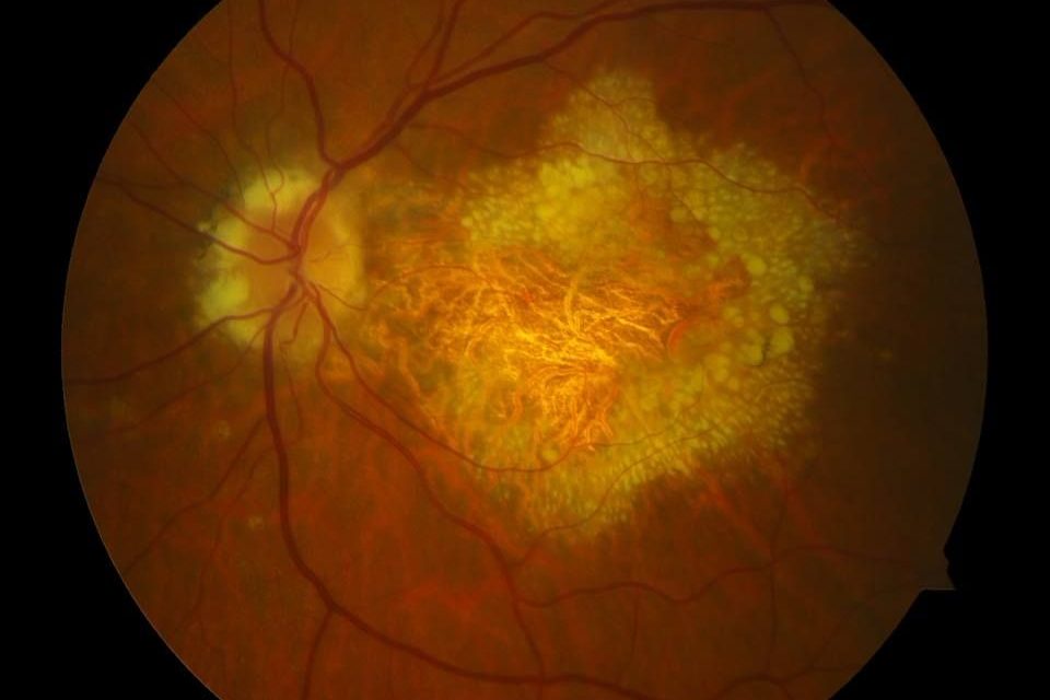 Doyne Honeycomb Retinal Dystrophy: All what you don’t know about