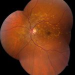 Stargardt Disease