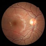 X-linked Retinoschisis