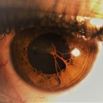 Persistent Pupillary Membrane