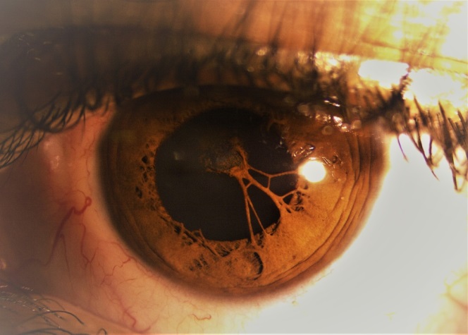 Persistent Pupillary Membrane: In-depth exploration