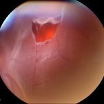 Horseshoe or Flap Tear