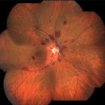 High Altitude Retinopathy