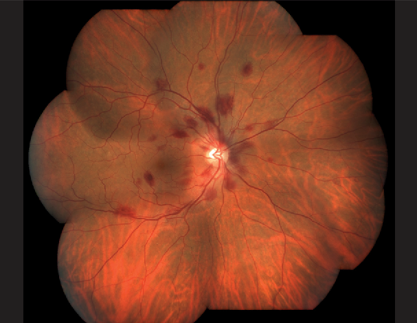 High Altitude Retinopathy (HAR):in-depth study