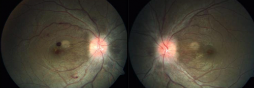 High Altitude Retinopathy