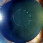 Pseudoexfoliation Syndrome