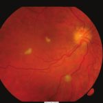 Ocular Candidiasis