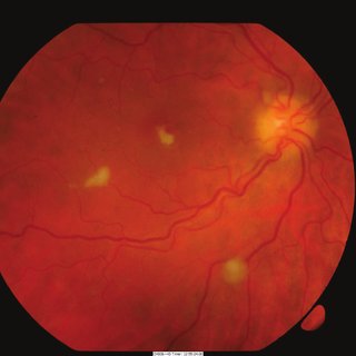 Ocular Candidiasis: Sight-Threatening Condition