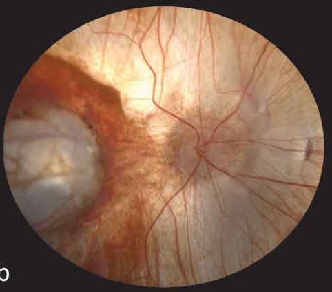 Knobloch Syndrome