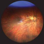 Knobloch Syndrome