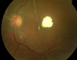 Ocular Candidiasis