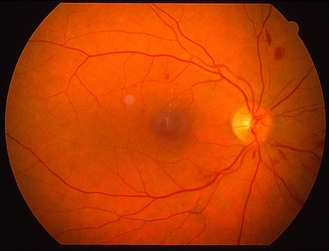 Hypertensive Retinopathy