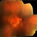 Myopic Traction Maculopathy