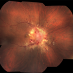 Hypertensive Retinopathy