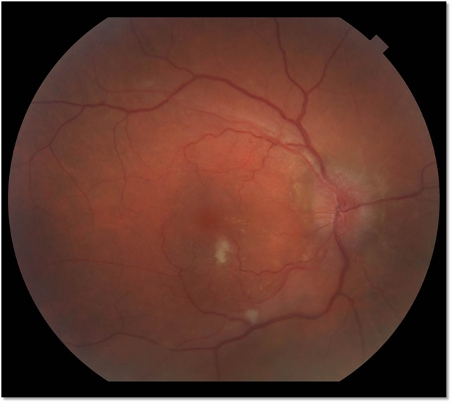 Hypertensive Retinopathy