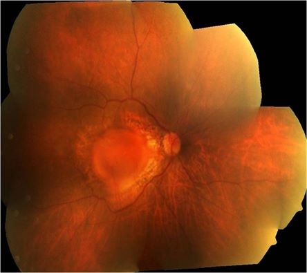 Myopic Traction Maculopathy: full study