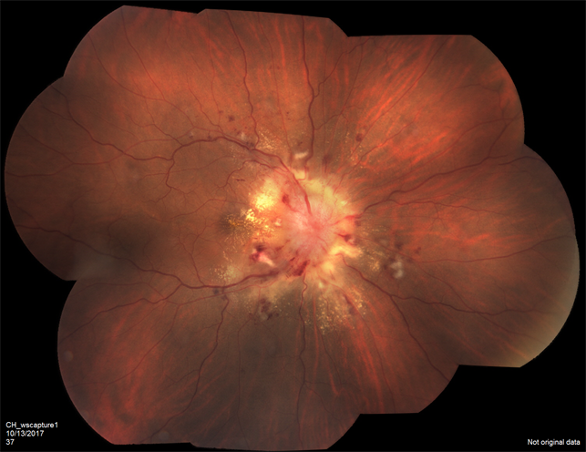 Hypertensive Retinopathy: from A to Z