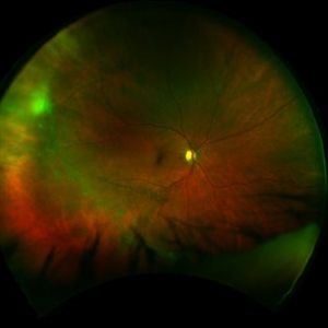 Macular Telangiectasia