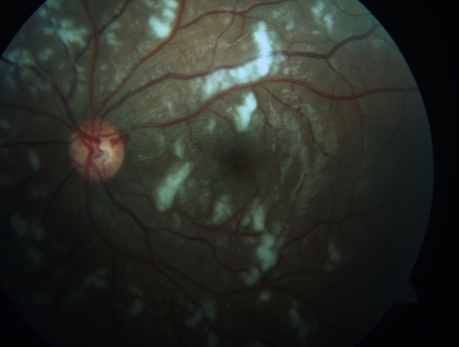 Purtscher Retinopathy