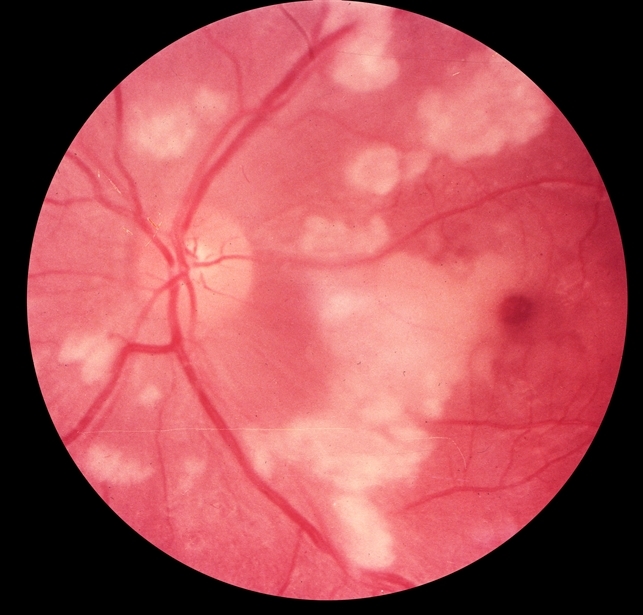 Purtscher Retinopathy