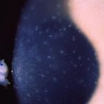 Meesmann Corneal Dystrophy (MCD)