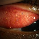 Ophthalmia Nodosa