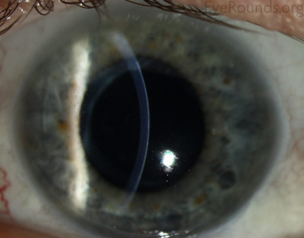 Meesmann Corneal Dystrophy (MCD)