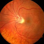 Stickler Syndrome