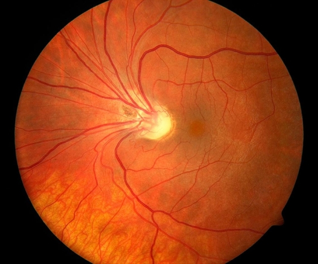 stickler syndrome retina