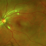 Purtscher Retinopathy