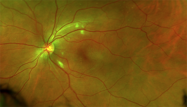 Purtscher Retinopathy: in depth review