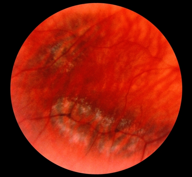 stickler syndrome retina