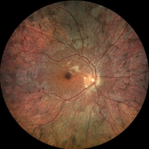 Choroideremia 