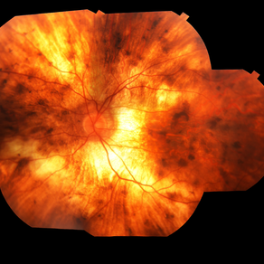 Choroideremia 