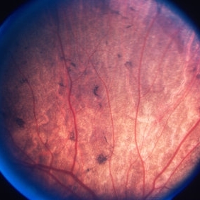 Choroideremia 