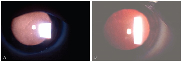 Meesmann Corneal Dystrophy (MCD)