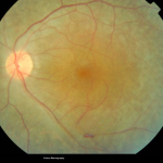 Usher Syndrome