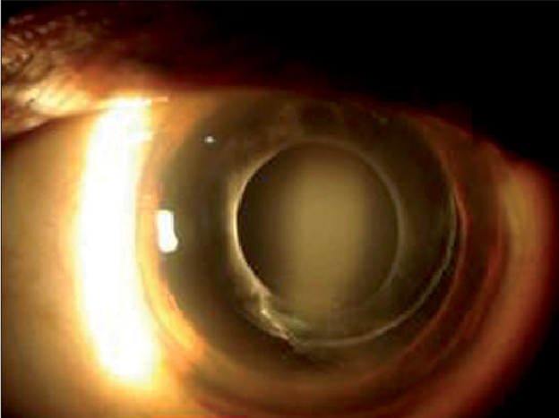 PPT - Chapter 9 Intraocular Lenses PowerPoint Presentation, free download -  ID:1482821
