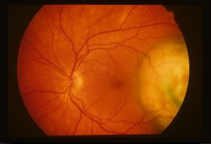 Exudative Retinal Detachment (RPE)