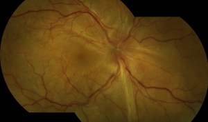 Exudative Retinal Detachment (RPE)